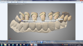 口腔内スキャナのデータのノウハウ